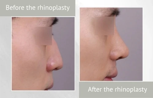 photos_before_and_after_rhinoplasty_eng Lienjang rhinoplasty before after