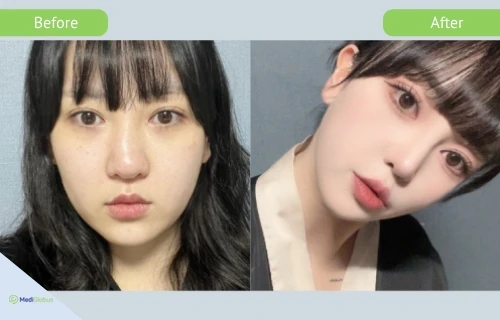 rhinoplasty_girin_before_after_eng rhinoplasty at girin hospital before after pictures