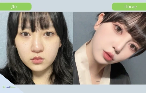 rhinoplasty_girin_before_after_rus до после ринопластики в клинике гирин