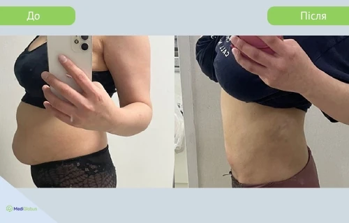 tummy_tuck_liposuction_girin_before_after_ukr до після підтяжки живота з ліпосакцією в клініці гірін
