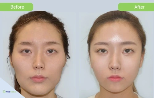 v_surgery_girin_before_after_eng v-shaped surgery at girin hospital before after pictures