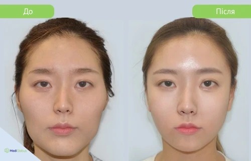 v_surgery_girin_before_after_ukr до після щелепно-лицевої операції в клініці гірін