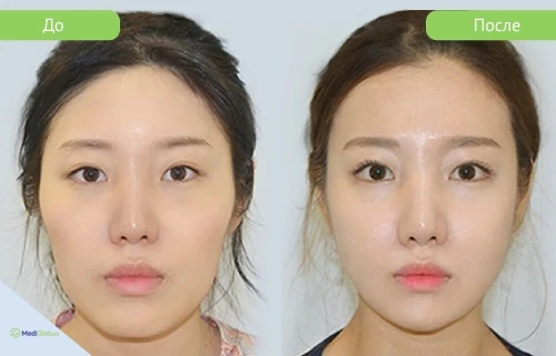 zygoma_girin_before_after_rus фото до после уменьшения скул в клинике гирин