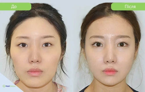 zygoma_girin_before_after_ukr фото до після зменшення скул в клініці гірін