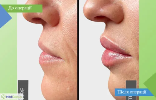 dentistry-fillers-2-ukr Порівняння до та після фото філлерів губ в Туреччині в клініці Вітрувіан