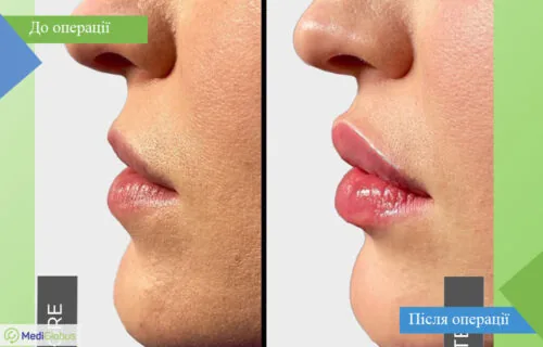dentistry-fillers-3-ukr Порівняння до та після фото філлерів губ в Туреччині в клініці Вітрувіан