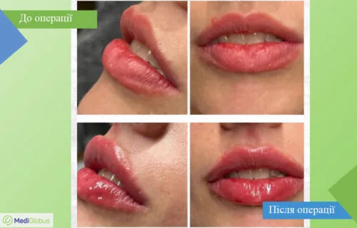 dentistry-fillers-4-ukr Порівняння до та після фото філлерів губ в Туреччині в клініці Вітрувіан