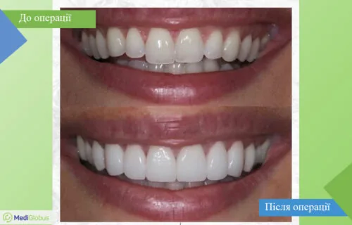 dentistry-vitruvian-1-ukr Порівняння до та після фото відбілювання зубів в клініці Вітрувіан