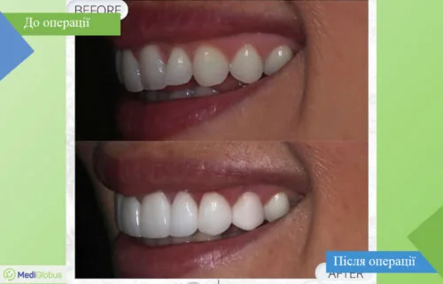 dentistry-vitruvian-2-ukr Порівняння до та після фото відбілювання зубів в клініці Вітрувіан