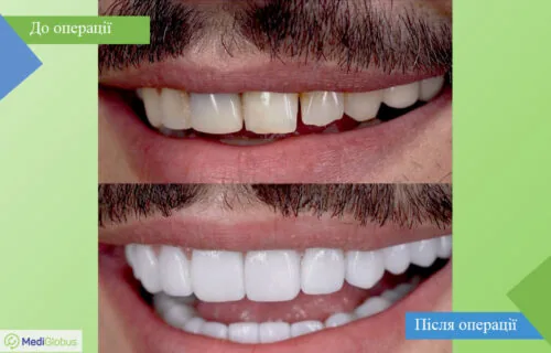dentistry-vitruvian-4-ukr Порівняння до та після фото відбілювання зубів в клініці Вітрувіан