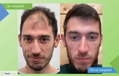 vitruvian-plastic-surgery-6-ukr Порівняння до та після фото пересадки \ трансплантації волосся в Туреччині в клініці Вітрувіан