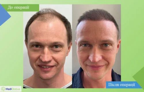 vitruvian-plastic-surgery-8-ukr Порівняння до та після фото пересадки \ трансплантації волосся в Туреччині в клініці Вітрувіан