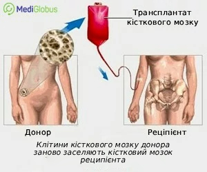 bonemarrow_transplantation_ukr Пересадка кісткового мозку від донора до реціпієнта