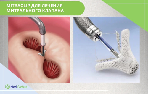 Слева показан процесс введения катетера MitraClip для скрепления створок митрального клапана сердца; справа крупным планом изображен сам металлический зажим MitraClip на конце доставочного устройства