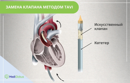 Медицинская схема замены аортального клапана методом TAVI. Слева показано сердце в разрезе с катетером в аорте. Справа — крупный план катетера со сжатым искусственным клапаном.